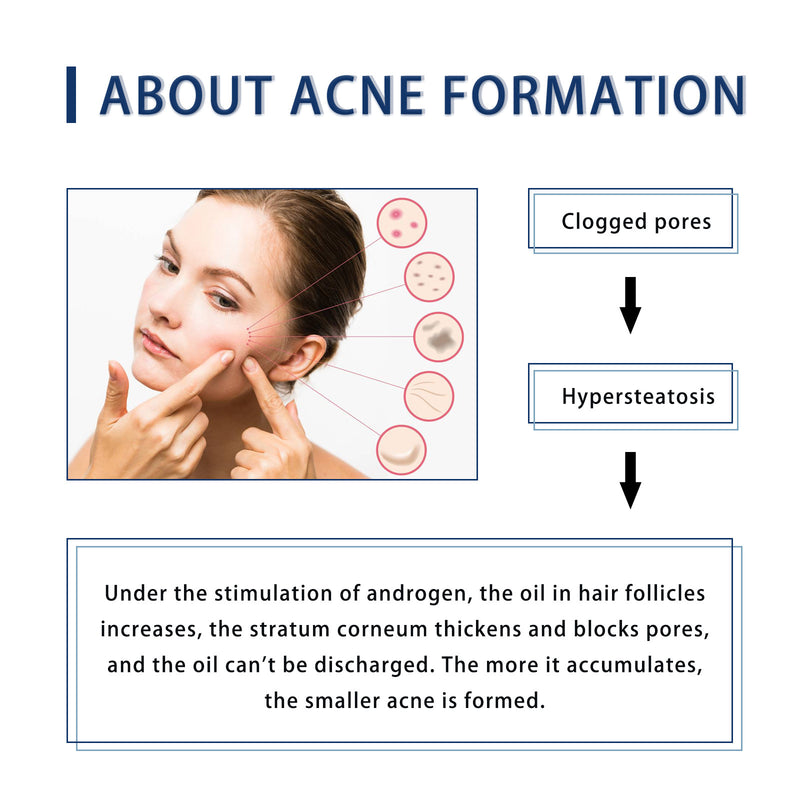 a woman with acne on her face