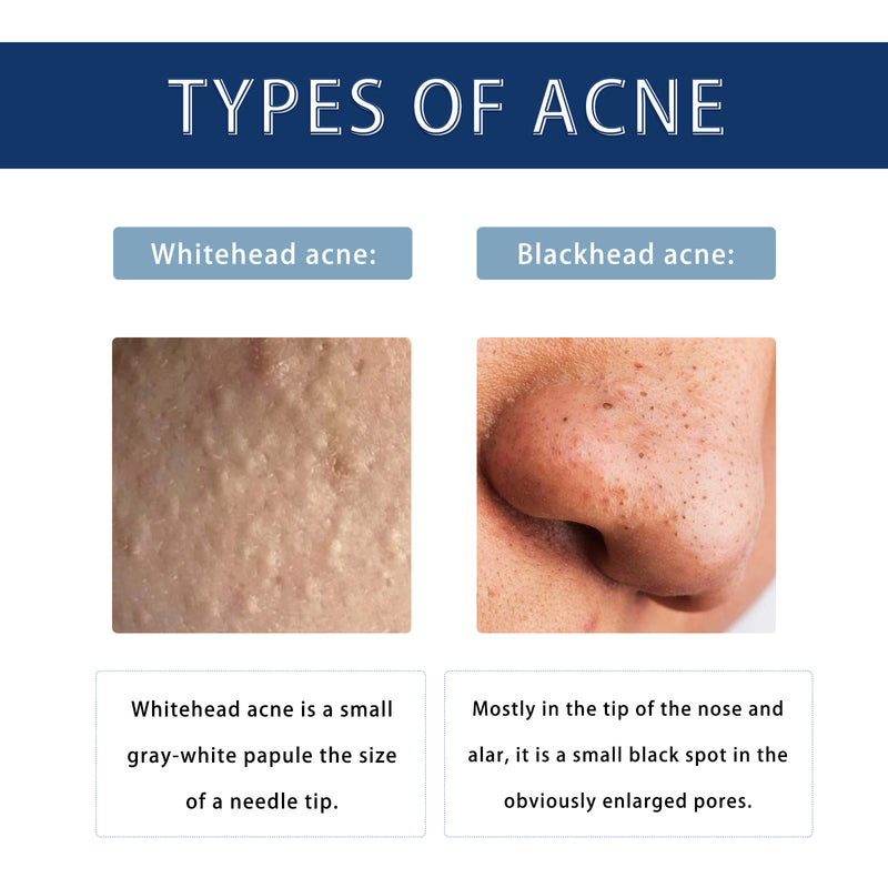 different types of acne